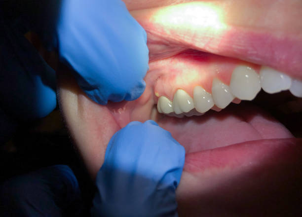 Best Tooth Infection Emergency Dentist  in Fort Clark Springs, TX